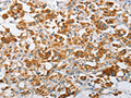 The image on the left is immunohistochemistry of paraffin-embedded Human thyroid cancer tissue using CSB-PA364661(ARHGEF9 Antibody) at dilution 1/50, on the right is treated with fusion protein. (Original magnification: ×200)