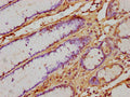 IHC image of CSB-PA365592HA01HU diluted at 1:500 and staining in paraffin-embedded human gastric cancer performed on a Leica BondTM system. After dewaxing and hydration, antigen retrieval was mediated by high pressure in a citrate buffer (pH 6.0). Section was blocked with 10% normal goat serum 30min at RT. Then primary antibody (1% BSA) was incubated at 4°C overnight. The primary is detected by a biotinylated secondary antibody and visualized using an HRP conjugated SP system.