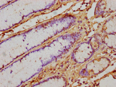 IHC image of CSB-PA365592HA01HU diluted at 1:500 and staining in paraffin-embedded human gastric cancer performed on a Leica BondTM system. After dewaxing and hydration, antigen retrieval was mediated by high pressure in a citrate buffer (pH 6.0). Section was blocked with 10% normal goat serum 30min at RT. Then primary antibody (1% BSA) was incubated at 4°C overnight. The primary is detected by a biotinylated secondary antibody and visualized using an HRP conjugated SP system.