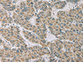 The image on the left is immunohistochemistry of paraffin-embedded Human liver cancer tissue using CSB-PA367981(RNASE3 Antibody) at dilution 1/20, on the right is treated with fusion protein. (Original magnification: ×200)