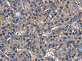 The image on the left is immunohistochemistry of paraffin-embedded Human liver cancer tissue using CSB-PA372865(IGFBP5 Antibody) at dilution 1/25, on the right is treated with fusion protein. (Original magnification: ×200)
