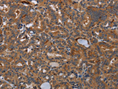 The image on the left is immunohistochemistry of paraffin-embedded Human thyroid cancer tissue using CSB-PA374084(KLK13 Antibody) at dilution 1/20, on the right is treated with fusion protein. (Original magnification: ×200)