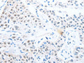 The image on the left is immunohistochemistry of paraffin-embedded Human lung cancer tissue using CSB-PA374601(POU2F1 Antibody) at dilution 1/25, on the right is treated with fusion protein. (Original magnification: ×200)