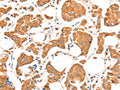 The image on the left is immunohistochemistry of paraffin-embedded Human breast cancer tissue using CSB-PA383927(ACSM5 Antibody) at dilution 1/20, on the right is treated with fusion protein. (Original magnification: ×200)