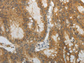 The image on the left is immunohistochemistry of paraffin-embedded Human colon cancer tissue using CSB-PA385632(OCLN Antibody) at dilution 1/10, on the right is treated with fusion protein. (Original magnification: ×200)