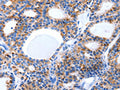 The image on the left is immunohistochemistry of paraffin-embedded Human thyroid cancer tissue using CSB-PA389898(LAMA5 Antibody) at dilution 1/8, on the right is treated with synthetic peptide. (Original magnification: ×200)