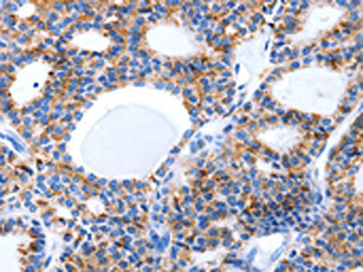 The image on the left is immunohistochemistry of paraffin-embedded Human thyroid cancer tissue using CSB-PA389898(LAMA5 Antibody) at dilution 1/8, on the right is treated with synthetic peptide. (Original magnification: ×200)