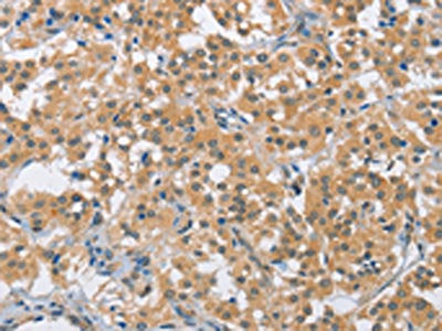 The image on the left is immunohistochemistry of paraffin-embedded Human thyroid cancer tissue using CSB-PA390581(BCL10 Antibody) at dilution 1/40, on the right is treated with fusion protein. (Original magnification: ×200)