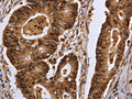 The image on the left is immunohistochemistry of paraffin-embedded Human colon cancer tissue using CSB-PA399518(EXTL3 Antibody) at dilution 1/30, on the right is treated with fusion protein. (Original magnification: ×200)