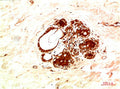Immunohistochemical analysis of paraffin-embedded Human Breast Carcinoma Tissue using JAK2 Rabbit  pAb diluted at 1:200