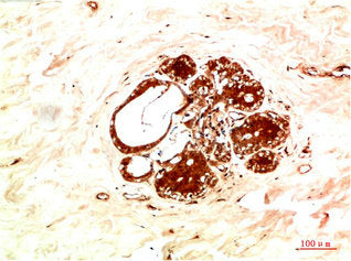 Immunohistochemical analysis of paraffin-embedded Human Breast Carcinoma Tissue using JAK2 Rabbit  pAb diluted at 1:200