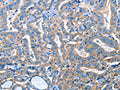 The image on the left is immunohistochemistry of paraffin-embedded Human thyroid cancer tissue using CSB-PA408174(ADH4 Antibody) at dilution 1/25, on the right is treated with fusion protein. (Original magnification: ×200)