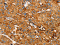 The image on the left is immunohistochemistry of paraffin-embedded Human liver cancer tissue using CSB-PA409215(RNF14 Antibody) at dilution 1/20, on the right is treated with fusion protein. (Original magnification: ×200)