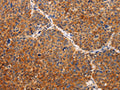 The image on the left is immunohistochemistry of paraffin-embedded Human liver cancer tissue using CSB-PA411062(TIMP2 Antibody) at dilution 1/20, on the right is treated with fusion protein. (Original magnification: ×200)