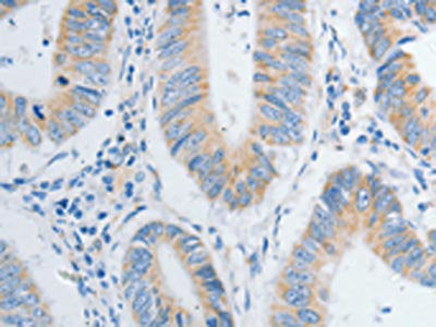 The image on the left is immunohistochemistry of paraffin-embedded Human colon cancer tissue using CSB-PA418151(NTF4 Antibody) at dilution 1/20, on the right is treated with fusion protein. (Original magnification: ×200)