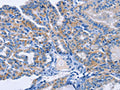 The image on the left is immunohistochemistry of paraffin-embedded Human thyroid cancer tissue using CSB-PA418436(AMACR Antibody) at dilution 1/30, on the right is treated with fusion protein. (Original magnification: ×200)