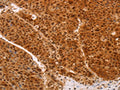 The image on the left is immunohistochemistry of paraffin-embedded Human liver cancer tissue using CSB-PA428601(HEXIM1 Antibody) at dilution 1/65, on the right is treated with fusion protein. (Original magnification: ×200)