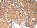 The image on the left is immunohistochemistry of paraffin-embedded Human breast cancer tissue using CSB-PA434737(BGLAP Antibody) at dilution 1/40, on the right is treated with synthetic peptide. (Original magnification: ×200)