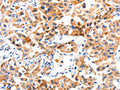 The image on the left is immunohistochemistry of paraffin-embedded Human lung cancer tissue using CSB-PA435870(JAK2 Antibody) at dilution 1/10, on the right is treated with synthetic peptide. (Original magnification: ×200)