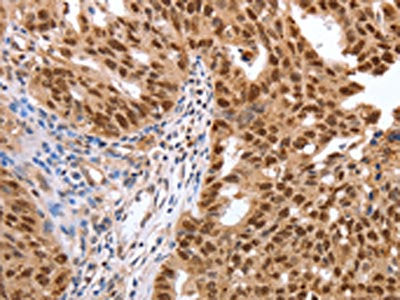 The image on the left is immunohistochemistry of paraffin-embedded Human ovarian cancer tissue using CSB-PA436053(PARP1 Antibody) at dilution 1/40, on the right is treated with synthetic peptide. (Original magnification: ×200)