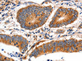 The image on the left is immunohistochemistry of paraffin-embedded Human colon cancer tissue using CSB-PA436421(MYH7 Antibody) at dilution 1/12, on the right is treated with fusion protein. (Original magnification: ×200)