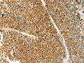 The image on the left is immunohistochemistry of paraffin-embedded Human liver cancer tissue using CSB-PA436548(TRAF1 Antibody) at dilution 1/20, on the right is treated with fusion protein. (Original magnification: ×200)