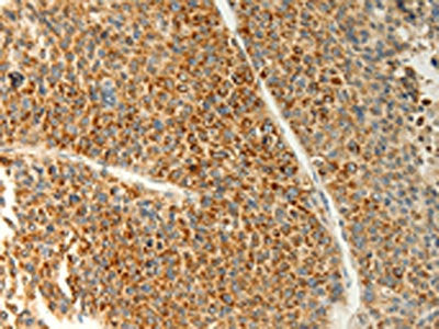 The image on the left is immunohistochemistry of paraffin-embedded Human liver cancer tissue using CSB-PA436548(TRAF1 Antibody) at dilution 1/20, on the right is treated with fusion protein. (Original magnification: ×200)