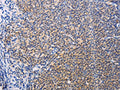 The image on the left is immunohistochemistry of paraffin-embedded Human lymphoma tissue using CSB-PA436831(SYK Antibody) at dilution 1/15, on the right is treated with fusion protein. (Original magnification: ×200)