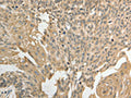 The image on the left is immunohistochemistry of paraffin-embedded Human cervical cancer tissue using CSB-PA436998(GSR Antibody) at dilution 1/50, on the right is treated with fusion protein. (Original magnification: ×200)