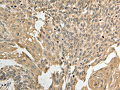 The image on the left is immunohistochemistry of paraffin-embedded Human cervical cancer tissue using CSB-PA436998(GSR Antibody) at dilution 1/50, on the right is treated with fusion protein. (Original magnification: ×200)