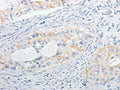 The image on the left is immunohistochemistry of paraffin-embedded Human cervical cancer tissue using CSB-PA437340(MPZ Antibody) at dilution 1/15, on the right is treated with fusion protein. (Original magnification: ×200)