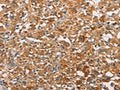 The image on the left is immunohistochemistry of paraffin-embedded Human thyroid cancer tissue using CSB-PA437351(PRKCE Antibody) at dilution 1/30, on the right is treated with fusion protein. (Original magnification: ×200)