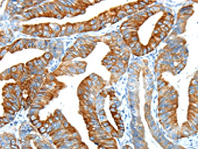 The image on the left is immunohistochemistry of paraffin-embedded Human esophagus cancer tissue using CSB-PA437416(F2 Antibody) at dilution 1/20, on the right is treated with synthetic peptide. (Original magnification: ×200)