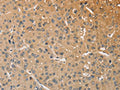 The image on the left is immunohistochemistry of paraffin-embedded Human liver cancer tissue using CSB-PA437651(WNT11 Antibody) at dilution 1/25, on the right is treated with fusion protein. (Original magnification: ×200)