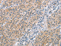 The image on the left is immunohistochemistry of paraffin-embedded Human gastic cancer tissue using CSB-PA438059(MCL1 Antibody) at dilution 1/60, on the right is treated with synthetic peptide. (Original magnification: ×200)