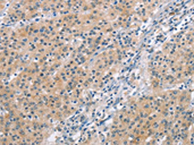 The image on the left is immunohistochemistry of paraffin-embedded Human gastic cancer tissue using CSB-PA438059(MCL1 Antibody) at dilution 1/60, on the right is treated with synthetic peptide. (Original magnification: ×200)