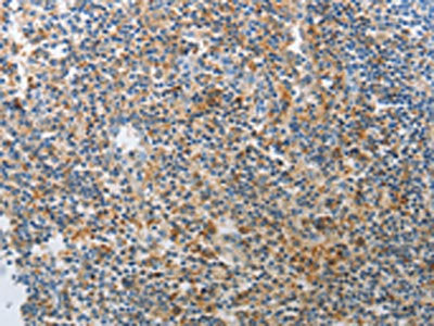 The image on the left is immunohistochemistry of paraffin-embedded Human tonsil tissue using CSB-PA438371(AD7C-NTP Antibody) at dilution 1/25, on the right is treated with synthetic peptide. (Original magnification: ×200)