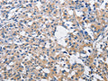 The image on the left is immunohistochemistry of paraffin-embedded Human thyroid cancer tissue using CSB-PA438428(PIM2 Antibody) at dilution 1/30, on the right is treated with fusion protein. (Original magnification: ×200)