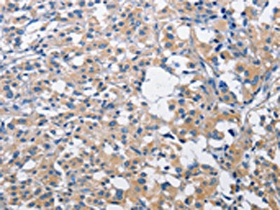 The image on the left is immunohistochemistry of paraffin-embedded Human thyroid cancer tissue using CSB-PA438428(PIM2 Antibody) at dilution 1/30, on the right is treated with fusion protein. (Original magnification: ×200)