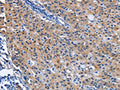 The image on the left is immunohistochemistry of paraffin-embedded Human gastic cancer tissue using CSB-PA438445(CDO1 Antibody) at dilution 1/40, on the right is treated with fusion protein. (Original magnification: ×200)