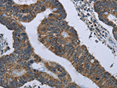 The image on the left is immunohistochemistry of paraffin-embedded Human colon cancer tissue using CSB-PA438683(GYPC Antibody) at dilution 1/60, on the right is treated with fusion protein. (Original magnification: ×200)