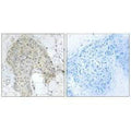 Immunohistochemistry analysis of paraffin-embedded human breast carcinoma tissue using PPP1R2 (Ab-120/121) antibody.