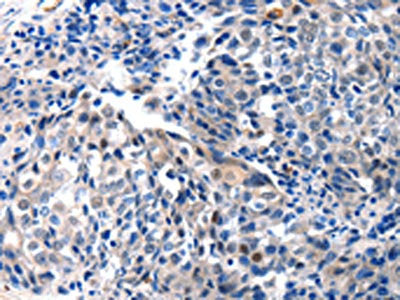The image on the left is immunohistochemistry of paraffin-embedded Human breast cancer tissue using CSB-PA439452(IGFBP7 Antibody) at dilution 1/25, on the right is treated with synthetic peptide. (Original magnification: ×200)