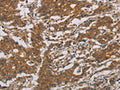 The image is immunohistochemistry of paraffin-embedded Human gastic cancer tissue using CSB-PA439589(CNDP1 Antibody) at dilution 1/30. (Original magnification: ×200)
