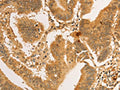 The image on the left is immunohistochemistry of paraffin-embedded Human colon cancer tissue using CSB-PA439706(RPL26L1 Antibody) at dilution 1/30, on the right is treated with fusion protein. (Original magnification: ×200)