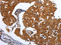The image on the left is immunohistochemistry of paraffin-embedded Human breast cancer tissue using CSB-PA439945(MAP2K1 Antibody) at dilution 1/25, on the right is treated with synthetic peptide. (Original magnification: ×200)