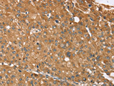 The image on the left is immunohistochemistry of paraffin-embedded Human liver cancer tissue using CSB-PA439984(NOS2 Antibody) at dilution 1/25, on the right is treated with synthetic peptide. (Original magnification: ×200)