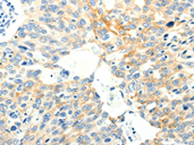 The image on the left is immunohistochemistry of paraffin-embedded Human ovarian cancer tissue using CSB-PA440250(SPAG5 Antibody) at dilution 1/35, on the right is treated with fusion protein. (Original magnification: ×200)