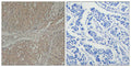 Immunohistochemical analysis of paraffin-embedded human breast carcinoma tissue using Smad3(Ab-208) Antibody(left) or the same antibody preincubated with blocking peptide(right).