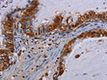 The image on the left is immunohistochemistry of paraffin-embedded Human esophagus cancer tissue using CSB-PA440474(MECP2 Antibody) at dilution 1/60, on the right is treated with fusion protein. (Original magnification: ×200)